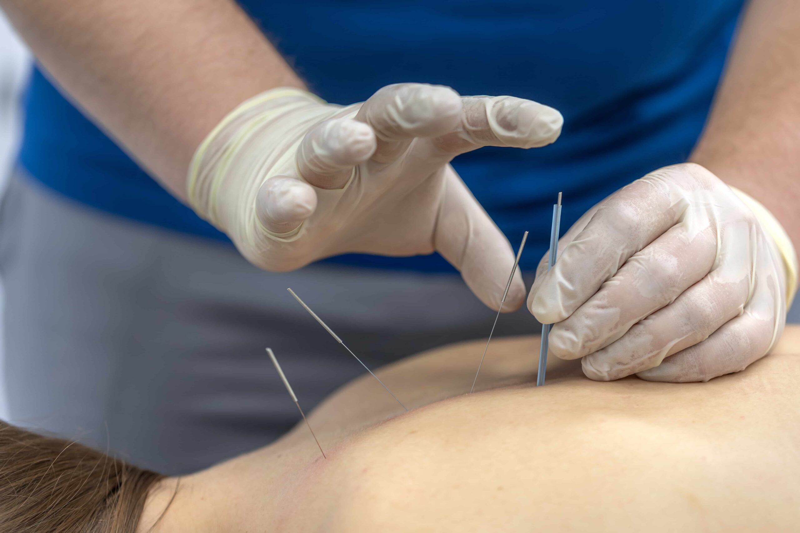 Why Choose Our Acupuncture Clinic in Chicago